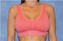 Breast Implant Revision Before Photo by George John Alexander, MD, FACS; Las Vegas, NV - Case 44105