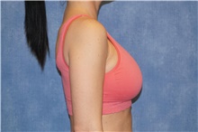 Breast Implant Revision After Photo by George John Alexander, MD, FACS; Las Vegas, NV - Case 44105
