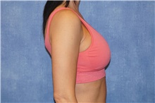 Breast Implant Revision Before Photo by George John Alexander, MD, FACS; Las Vegas, NV - Case 44105