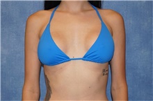 Breast Implant Revision Before Photo by George John Alexander, MD, FACS; ,  - Case 44205