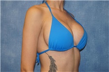 Breast Implant Revision After Photo by George John Alexander, MD, FACS; ,  - Case 44205