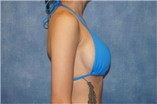 Breast Implant Revision After Photo by George John Alexander, MD, FACS; ,  - Case 44205
