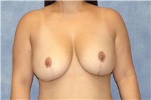 Breast Reduction After Photo by George John Alexander, MD, FACS; Las Vegas, NV - Case 44495