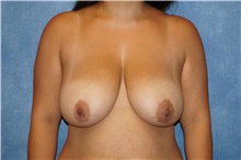 Breast Reduction Before Photo by George John Alexander, MD, FACS; Las Vegas, NV - Case 44495