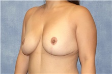 Breast Reduction After Photo by George John Alexander, MD, FACS; Las Vegas, NV - Case 44495