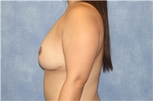Breast Reduction After Photo by George John Alexander, MD, FACS; Las Vegas, NV - Case 44495