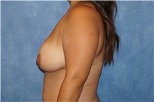 Breast Reduction Before Photo by George John Alexander, MD, FACS; Las Vegas, NV - Case 44495