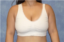 Breast Reduction After Photo by George John Alexander, MD, FACS; Las Vegas, NV - Case 44495