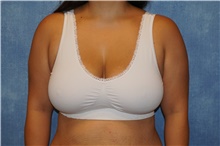 Breast Reduction Before Photo by George John Alexander, MD, FACS; Las Vegas, NV - Case 44495