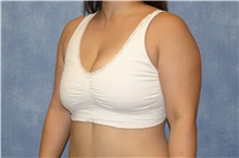 Breast Reduction After Photo by George John Alexander, MD, FACS; Las Vegas, NV - Case 44495