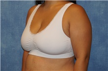 Breast Reduction Before Photo by George John Alexander, MD, FACS; Las Vegas, NV - Case 44495