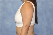 Breast Reduction After Photo by George John Alexander, MD, FACS; Las Vegas, NV - Case 44495