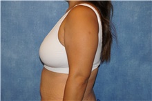 Breast Reduction Before Photo by George John Alexander, MD, FACS; Las Vegas, NV - Case 44495