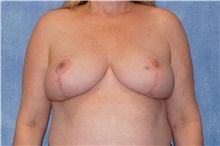 Breast Reduction After Photo by George John Alexander, MD, FACS; ,  - Case 44498