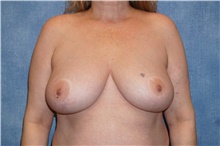 Breast Reduction Before Photo by George John Alexander, MD, FACS; ,  - Case 44498