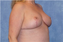 Breast Reduction After Photo by George John Alexander, MD, FACS; Las Vegas, NV - Case 44498