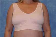 Breast Reduction After Photo by George John Alexander, MD, FACS; Las Vegas, NV - Case 44498