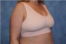 Breast Reduction Before Photo by George John Alexander, MD, FACS; Las Vegas, NV - Case 44498