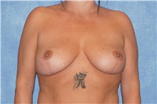 Breast Lift After Photo by George John Alexander, MD, FACS; ,  - Case 44500