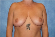 Breast Lift Before Photo by George John Alexander, MD, FACS; ,  - Case 44500