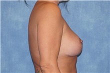 Breast Lift After Photo by George John Alexander, MD, FACS; ,  - Case 44500