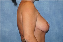 Breast Lift Before Photo by George John Alexander, MD, FACS; ,  - Case 44500