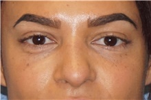 Rhinoplasty After Photo by George John Alexander, MD, FACS; ,  - Case 44505