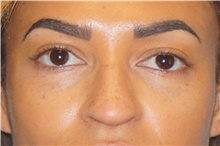 Rhinoplasty Before Photo by George John Alexander, MD, FACS; ,  - Case 44505