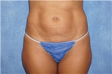 Tummy Tuck Before Photo by George John Alexander, MD, FACS; ,  - Case 44512