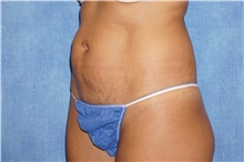 Tummy Tuck Before Photo by George John Alexander, MD, FACS; ,  - Case 44512