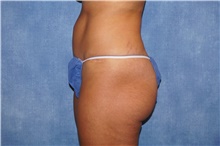 Tummy Tuck After Photo by George John Alexander, MD, FACS; ,  - Case 44512
