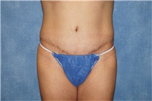 Tummy Tuck After Photo by George John Alexander, MD, FACS; Las Vegas, NV - Case 44514