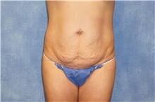 Tummy Tuck Before Photo by George John Alexander, MD, FACS; Las Vegas, NV - Case 44514
