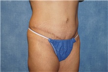 Tummy Tuck After Photo by George John Alexander, MD, FACS; ,  - Case 44514