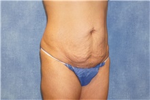 Tummy Tuck Before Photo by George John Alexander, MD, FACS; ,  - Case 44514