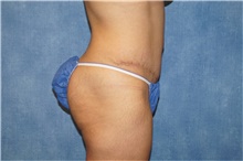 Tummy Tuck After Photo by George John Alexander, MD, FACS; ,  - Case 44514