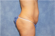 Tummy Tuck Before Photo by George John Alexander, MD, FACS; ,  - Case 44514