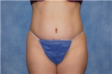 Tummy Tuck After Photo by George John Alexander, MD, FACS; Las Vegas, NV - Case 44516