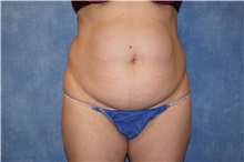 Tummy Tuck Before Photo by George John Alexander, MD, FACS; Las Vegas, NV - Case 44516