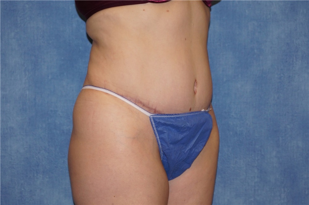 Tummy Tuck Before and After Photos by George John Alexander, MD, FACS; Las  Vegas, NV - Case 44516