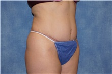 Tummy Tuck After Photo by George John Alexander, MD, FACS; ,  - Case 44516