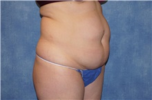 Tummy Tuck Before Photo by George John Alexander, MD, FACS; ,  - Case 44516