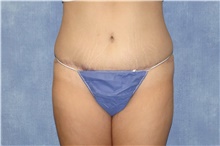 Tummy Tuck After Photo by George John Alexander, MD, FACS; Las Vegas, NV - Case 44518
