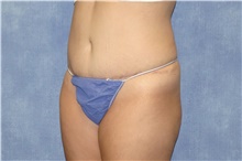 Tummy Tuck After Photo by George John Alexander, MD, FACS; Las Vegas, NV - Case 44518