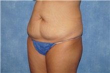 Tummy Tuck Before Photo by George John Alexander, MD, FACS; Las Vegas, NV - Case 44518