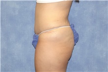 Tummy Tuck After Photo by George John Alexander, MD, FACS; Las Vegas, NV - Case 44518
