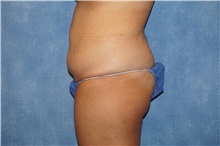Tummy Tuck Before Photo by George John Alexander, MD, FACS; Las Vegas, NV - Case 44518