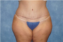 Tummy Tuck After Photo by George John Alexander, MD, FACS; ,  - Case 44519
