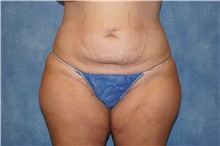 Tummy Tuck Before Photo by George John Alexander, MD, FACS; ,  - Case 44519