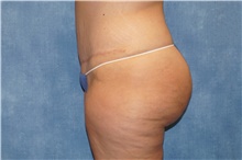 Tummy Tuck After Photo by George John Alexander, MD, FACS; ,  - Case 44519